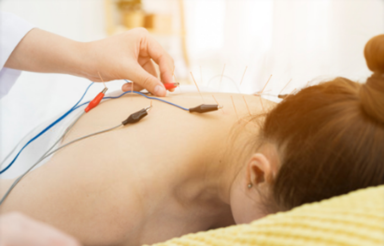 Điện châm điều trị liệt tứ chi do chấn thượng cột sống (Liệt hai chân và liệt tứ chi) (Nuy chứng, kính chứng)